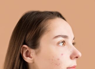 Teenager with acne