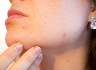 Woman's face with pimples